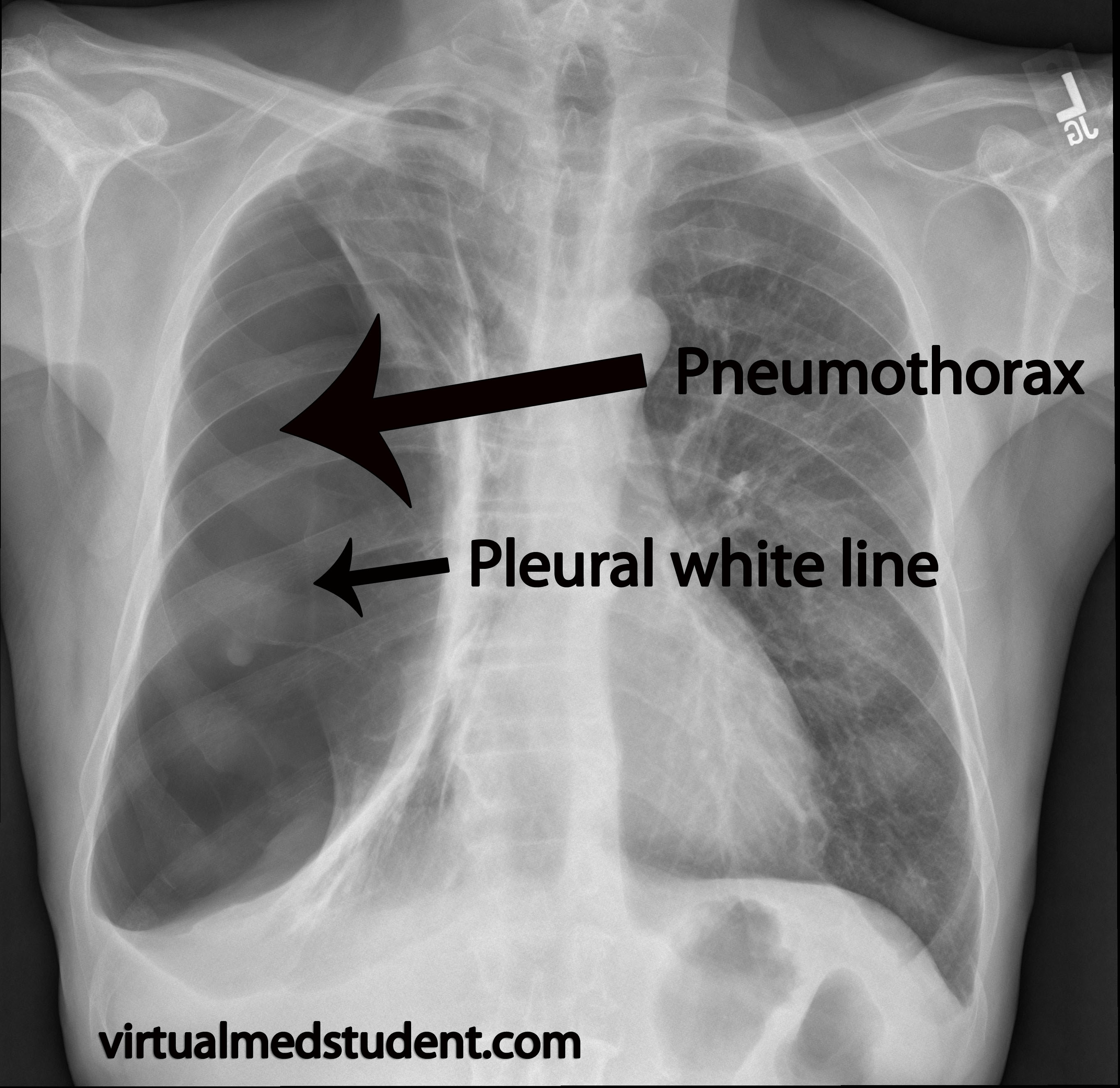 Pneumothorax Visceral And Parietal Pleura And A Little Air In Between