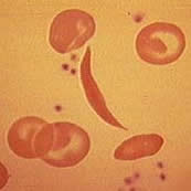 Sickle Cell Under Microscope
