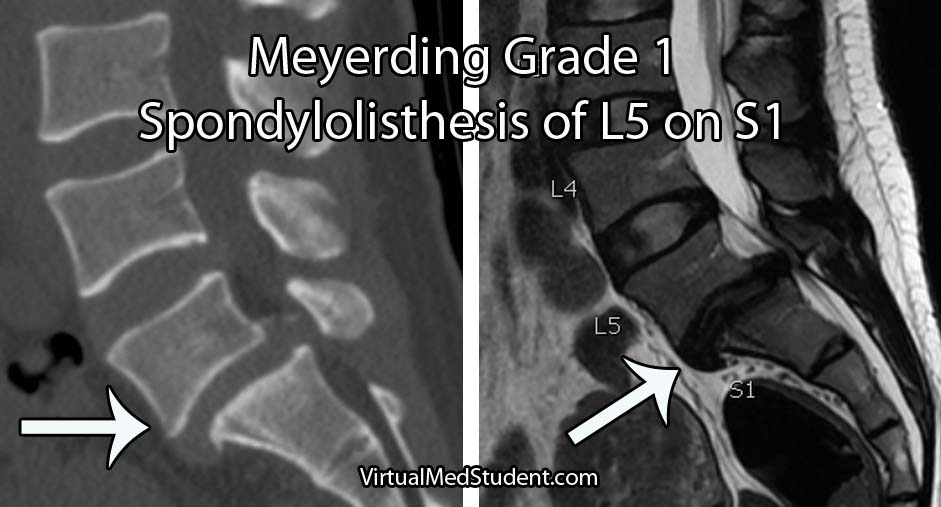 Spondylolisthesis MRI CT Sagittal Grade One L5 S1 