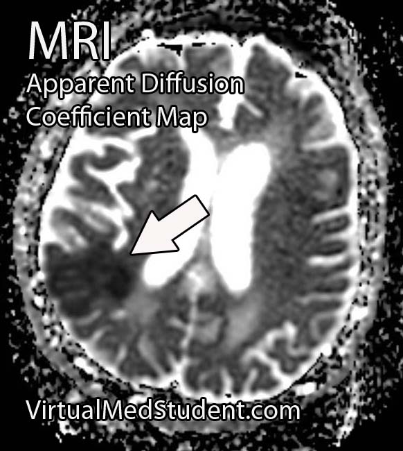 Stroke - ADC Map