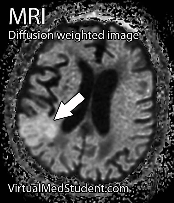 Stroke - Diffusion Weighted