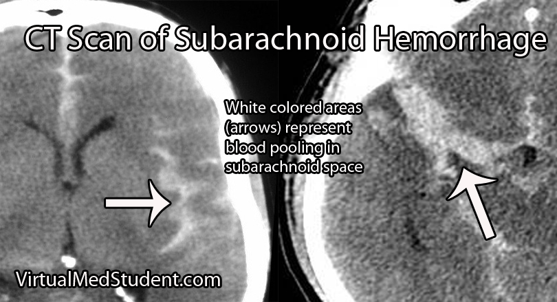 CT Scan of Subarachnoid Hemorrhage