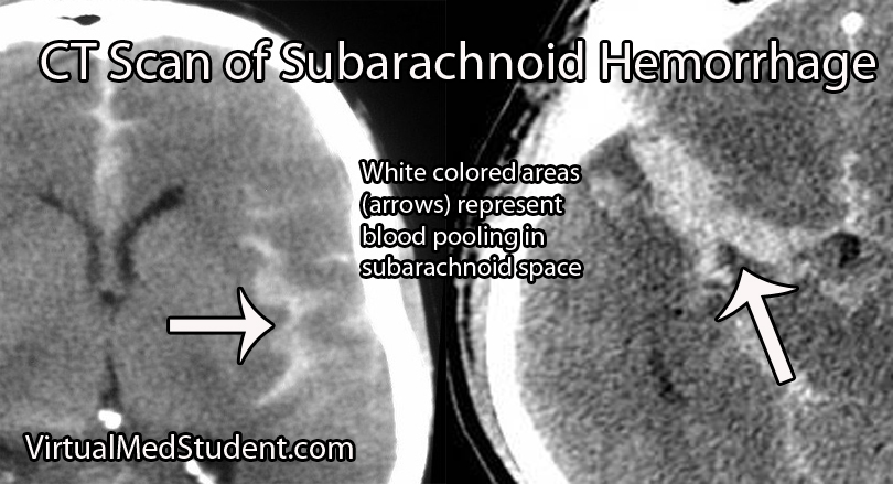 Subarachnoid Hemorrhage