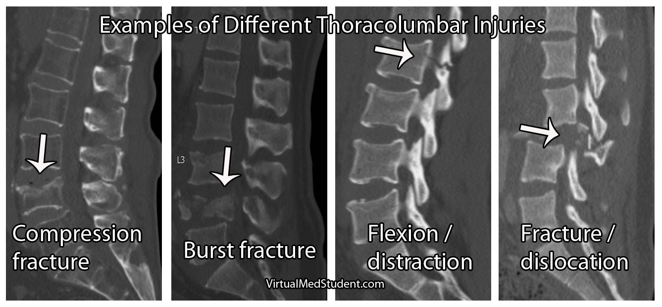 Examples of Thoracolumbar Spine Fractures