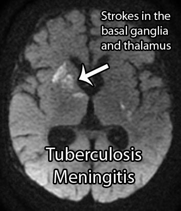 TB Meningitis MRI