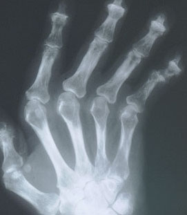 VirtualMedStudent.com || Rheumatoid Arthritis