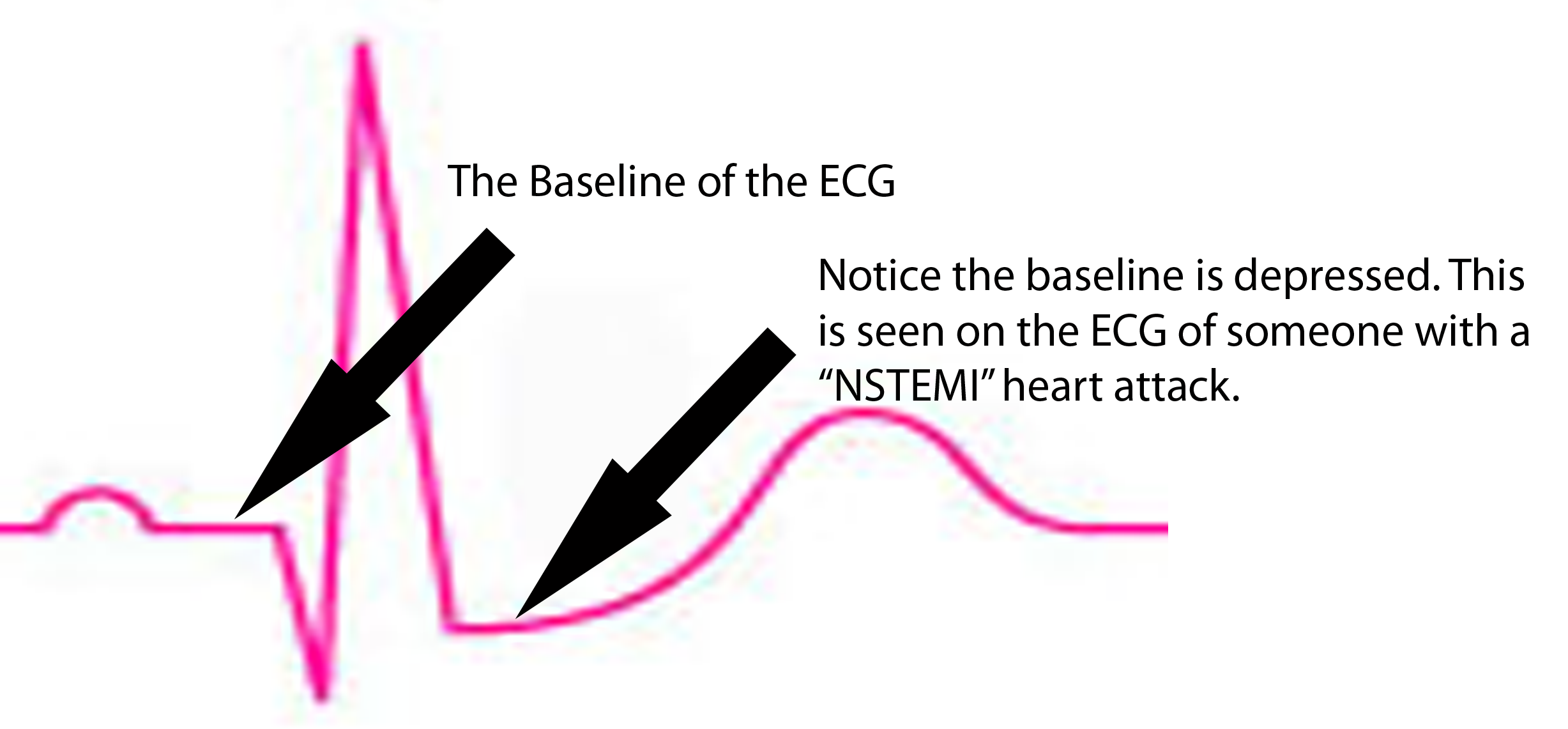 NSTEMI ECG